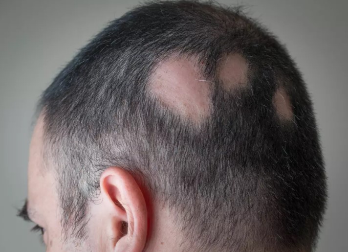 alopecia1