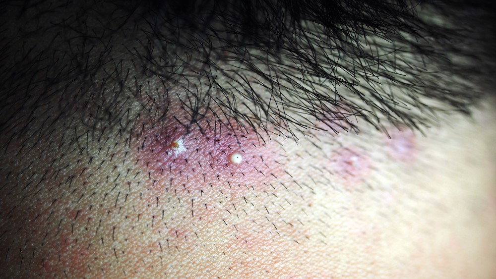 Folliculitis Induced by Laser Hair Removal: Proposed Mechanism and Treatment  | JCAD | The Journal of Clinical and Aesthetic Dermatology
