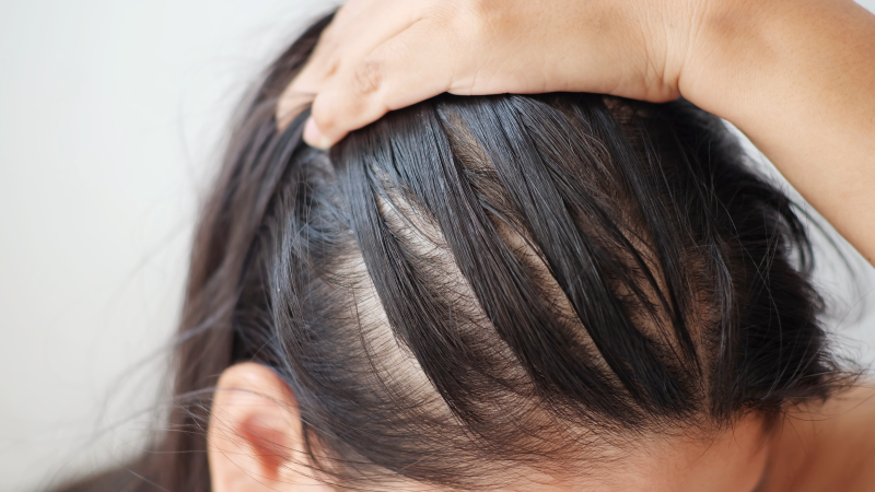 Hair Loss  cause symptoms treatment  prevention