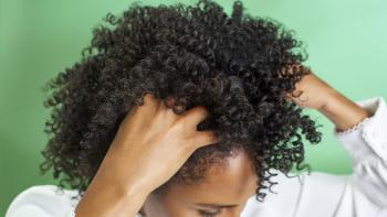 Dandruff Q&A: Causes & Treatments
