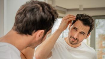 What is Alopecia Areata?