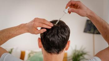Treating Hair Loss with Minoxidil