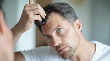 Treating Male Pattern Hair Loss