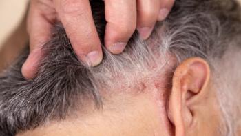 Psoriasis on your scalp