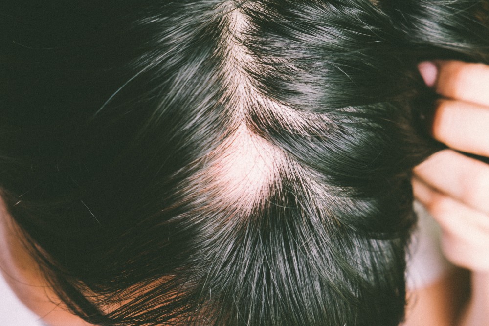 Shampoo per alopecia areata