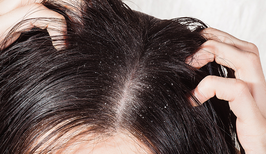 FAQ: Dandruff - Blog